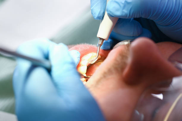 Best Emergency Tooth Extraction in Farngton Hills, MI